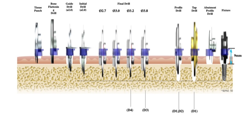 Drill sequence for a 4.5 × 10 mm implant with a 9 mm sleeve offset: tissue punch, bone flattening drill, guide drill, initial drill, final drills Ø2.7 to Ø3.8, profile drill, tap drill, abutment profile drill and fixture