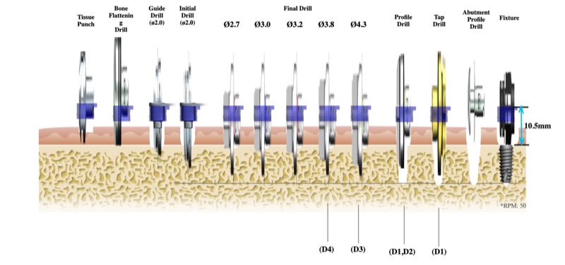 Drill sequence for a 5.0 × 10 mm implant with a 10.5 mm sleeve offset, final drills Ø2.7 to Ø4.3