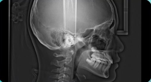 CBCT