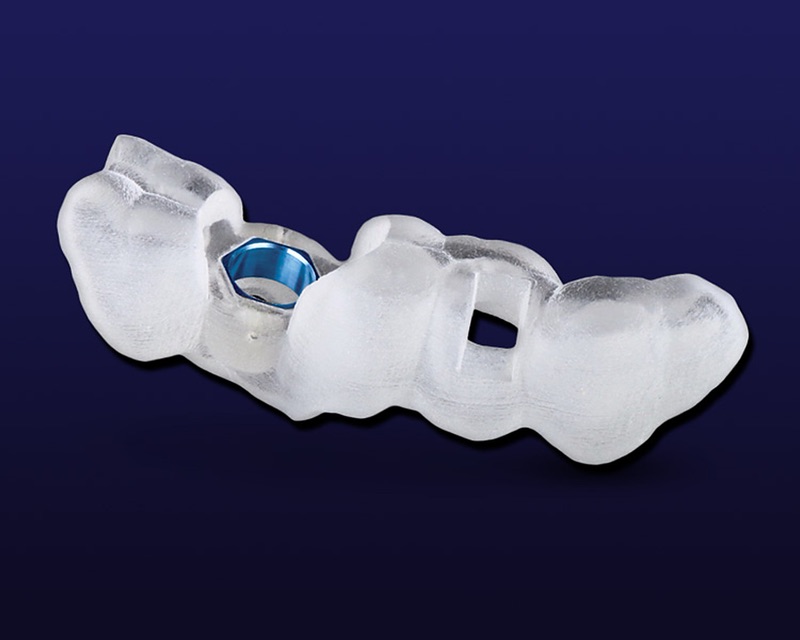 A Guide Doc® tooth-supported surgical guide in clear resin with a blue metal drill sleeve and an inspection window