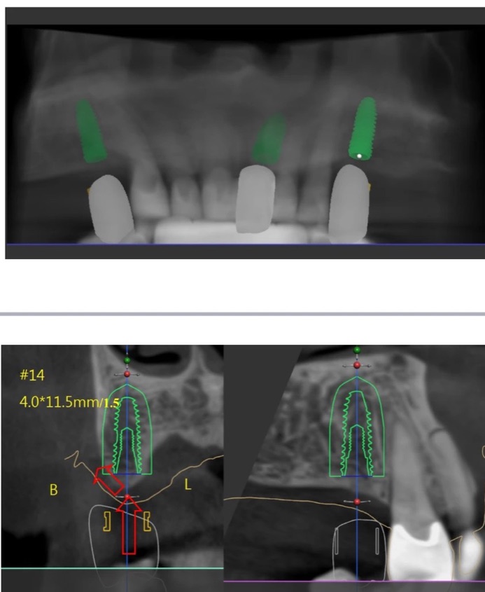 Surgical planning