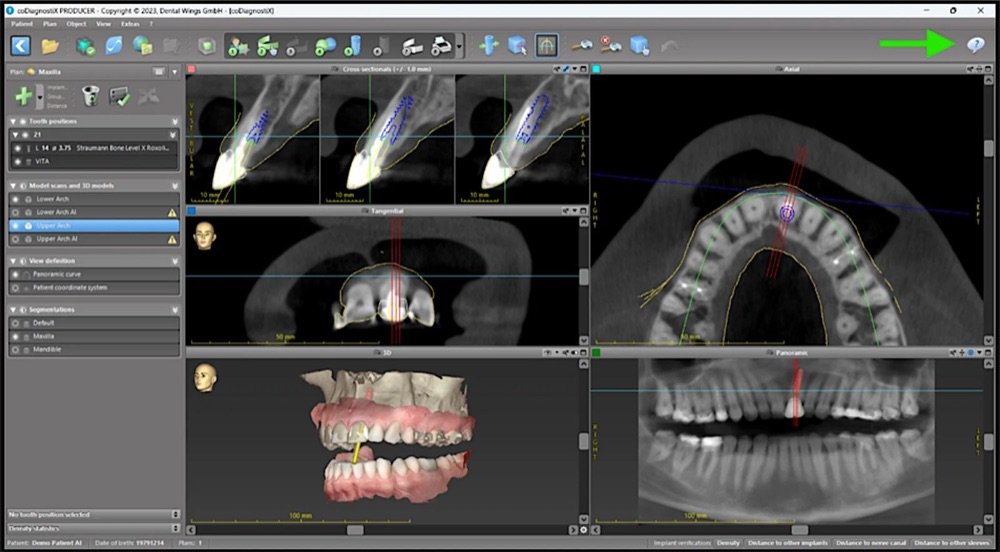Implant planning screen with cross-sections, axial view, 3D model and panoramic