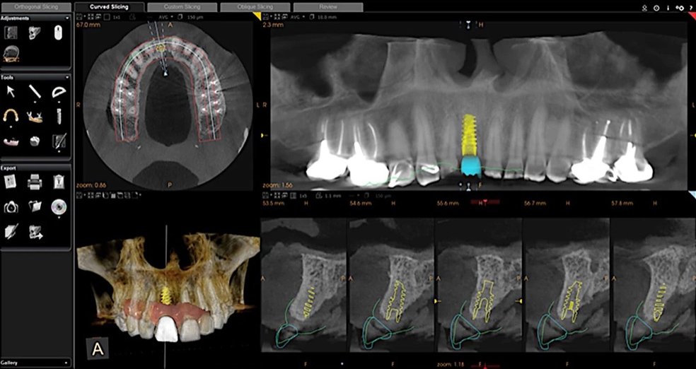 Curved slicing view with a planned implant in the upper front jaw