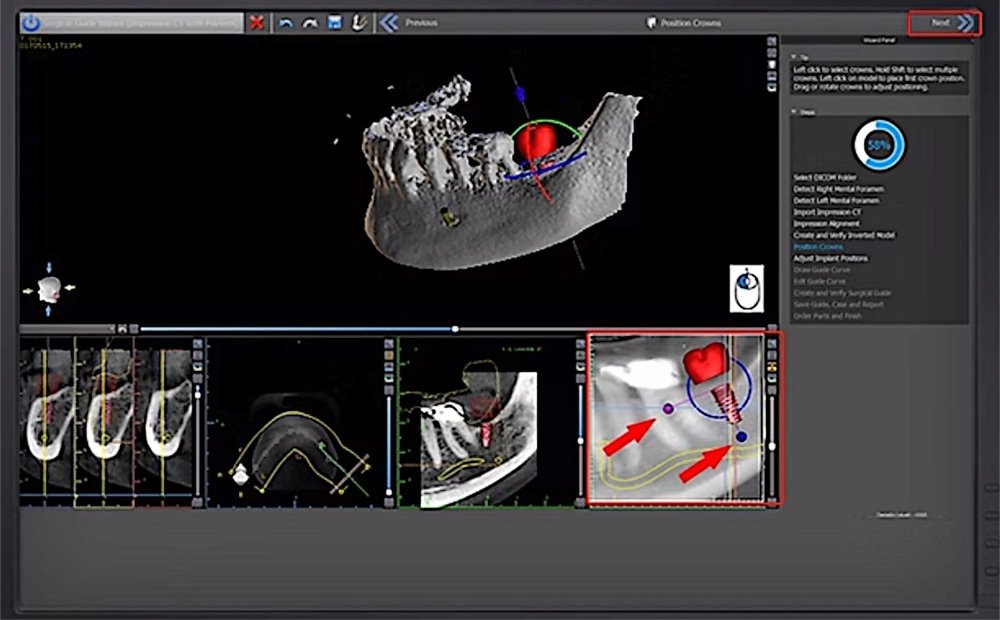 Surgical guide wizard placing a crown and implant over the jaw